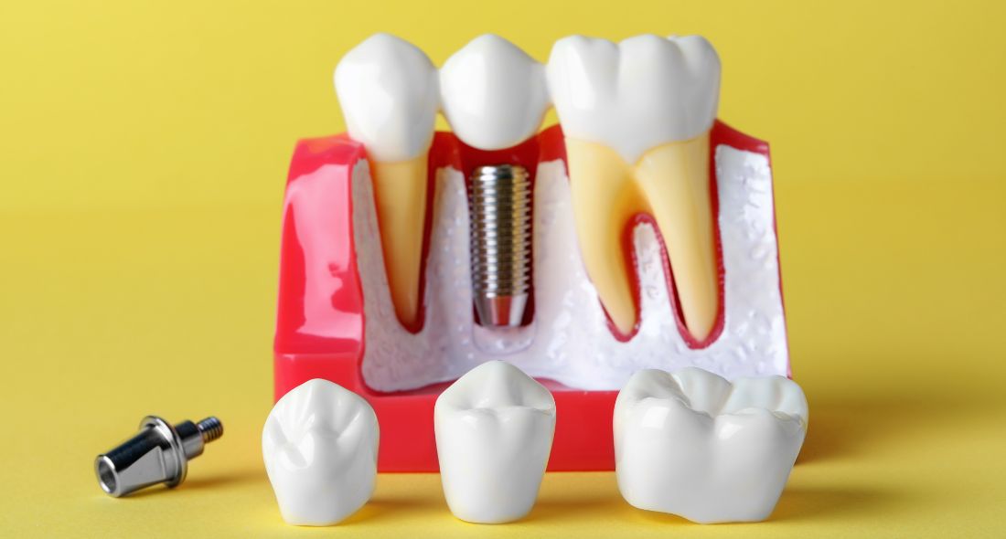 Dental Crowns: Procedure Types And Benefits
