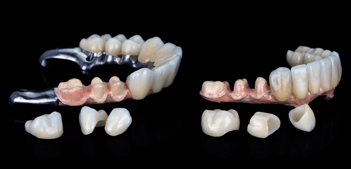 Can Dental Bridge be Done in One Day