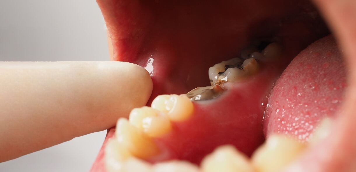 Cavity in Wisdom Tooth - JP Dental