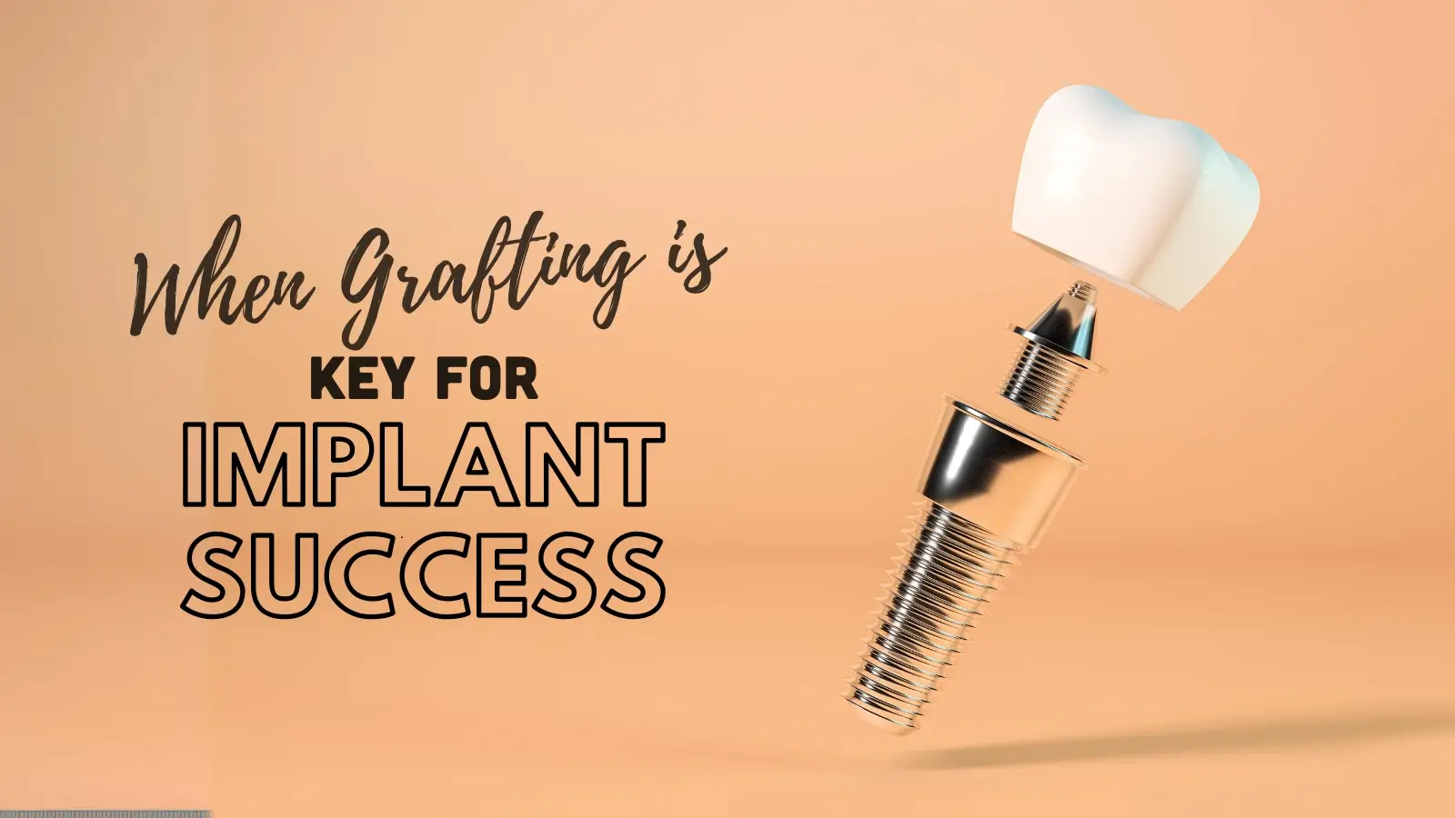 When Grafting is Key for Implant Success