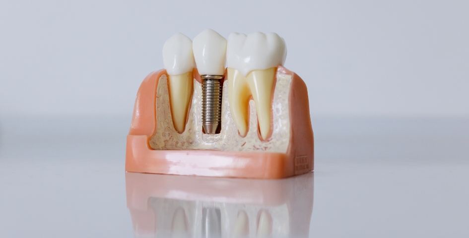 how long the dental implant process takes