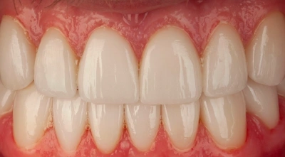 After complete mouth reconstruction restoring oral health.