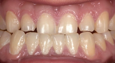Before complete mouth reconstruction.