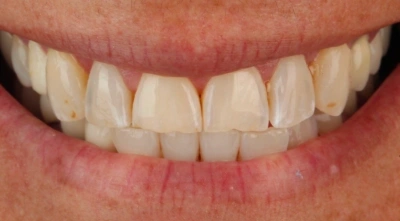 Before complete smile makeover.
