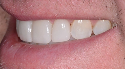 After correcting peg lateral teeth using ceramic restorations on the front teeth.