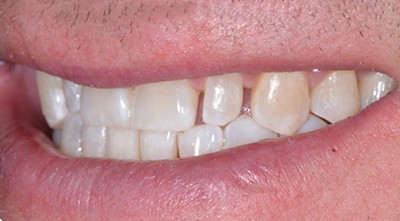 Before correcting peg lateral teeth with ceramic restorations.