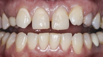Before cosmetic smile makeover treatment.