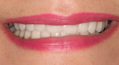 After full-mouth reconstruction restoring smile function.