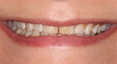Before full-mouth reconstruction treatment.