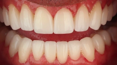 After full-mouth restoration with improved appearance and bite.