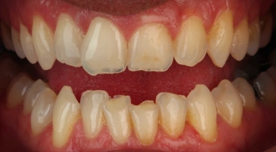 Before full-mouth restoration.