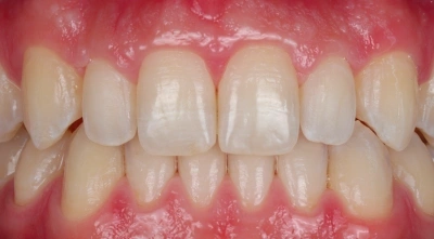 After Invisalign treatment with straighter teeth and improved bite.