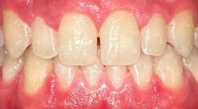 Before Invisalign treatment showing crowded teeth.