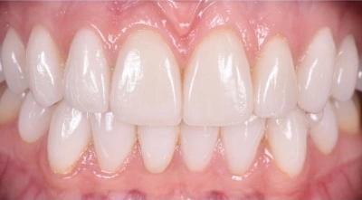 After treatment with custom ceramic veneers.