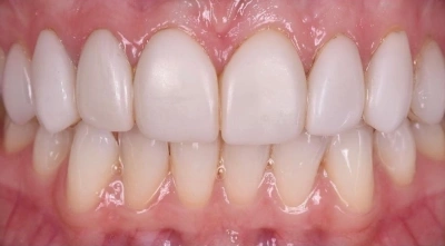 Before replacing bonded veneers.