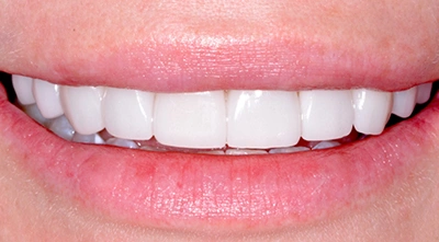 After smile transformation with new custom ceramic veneers replacing old bonded veneers.