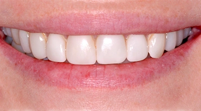 Before replacing old bonded veneers with custom ceramic veneers.