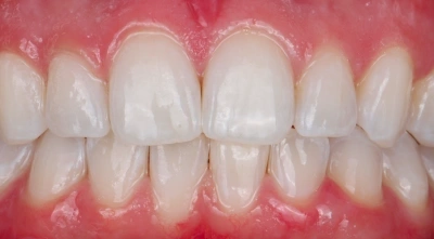 After professional teeth whitening with a noticeably brighter smile.