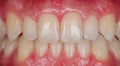 Before professional teeth whitening treatment.