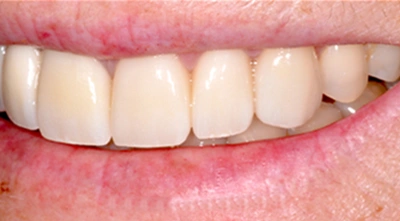 After replacing old ceramic restorations with natural-looking ceramics.