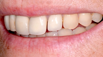 Before replacing worn ceramic restorations during a smile makeover.