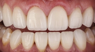 After cosmetic smile enhancement with improved tooth appearance.