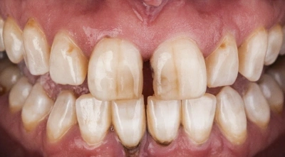 Before cosmetic smile enhancement treatment.