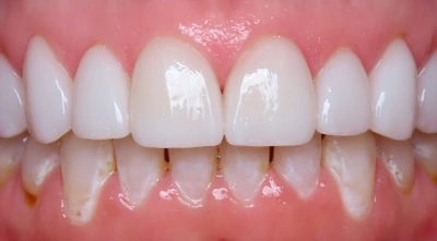 After complete smile makeover with brighter, balanced teeth.