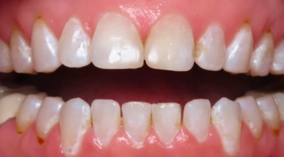 Before comprehensive cosmetic smile makeover.