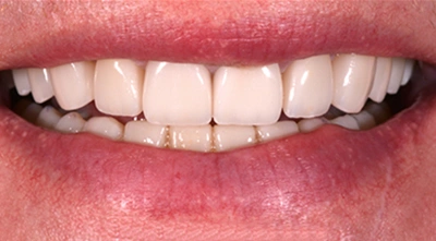 After smile reconstruction restoring healthy front teeth.