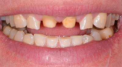 Before smile reconstruction for damaged and missing front teeth.