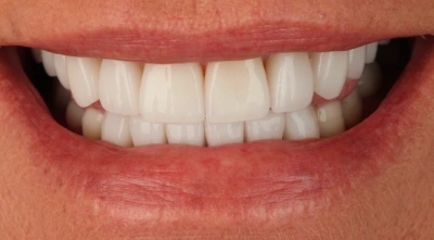 After smile restoration with improved function and appearance.