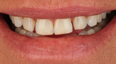 Before restorative dental treatment.