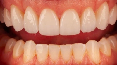 After cosmetic smile transformation with improved alignment and color.