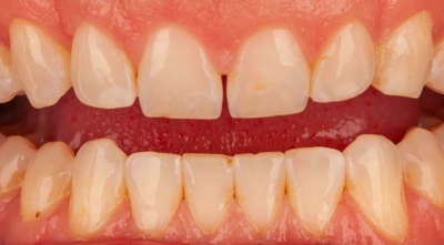 Before cosmetic smile transformation.