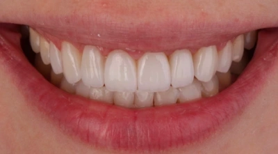 After complete smile transformation with cosmetic dentistry.