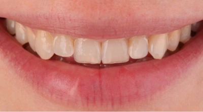 Before total smile transformation.