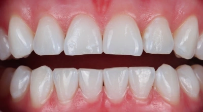 After cosmetic teeth whitening treatment.