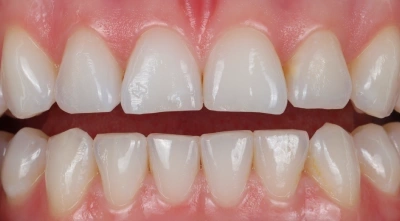 Before cosmetic teeth whitening treatment.