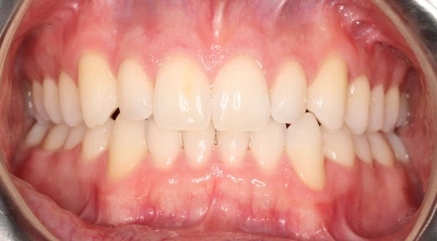 After correcting tooth alignment.