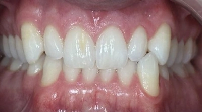Before correcting tooth alignment.