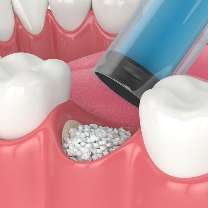 Reviving Bone Support with Advanced Grafting