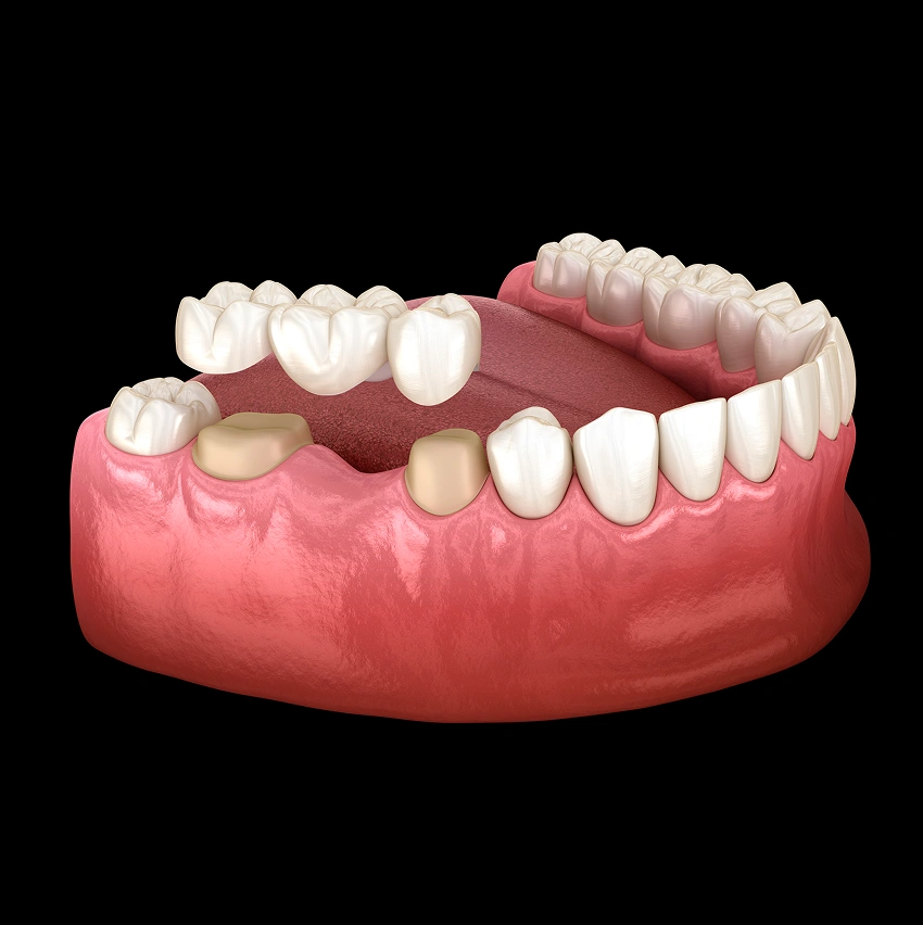 Understanding Dental Bridges
