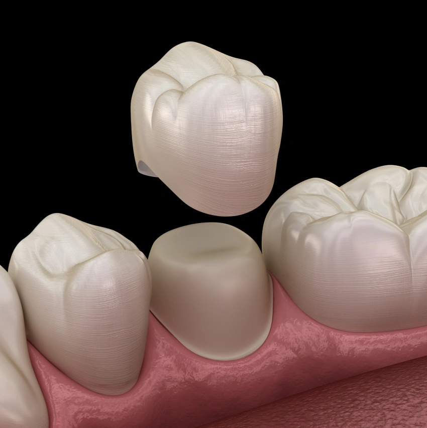 Restore The Integrity Of Your Teeth