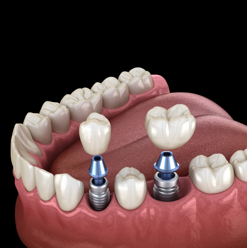 Replace Missing Teeth With Dental Implants