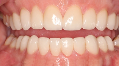 After full-mouth dental restoration.