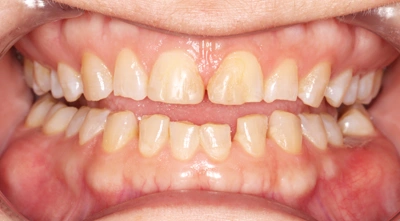 Before full-mouth dental treatment.