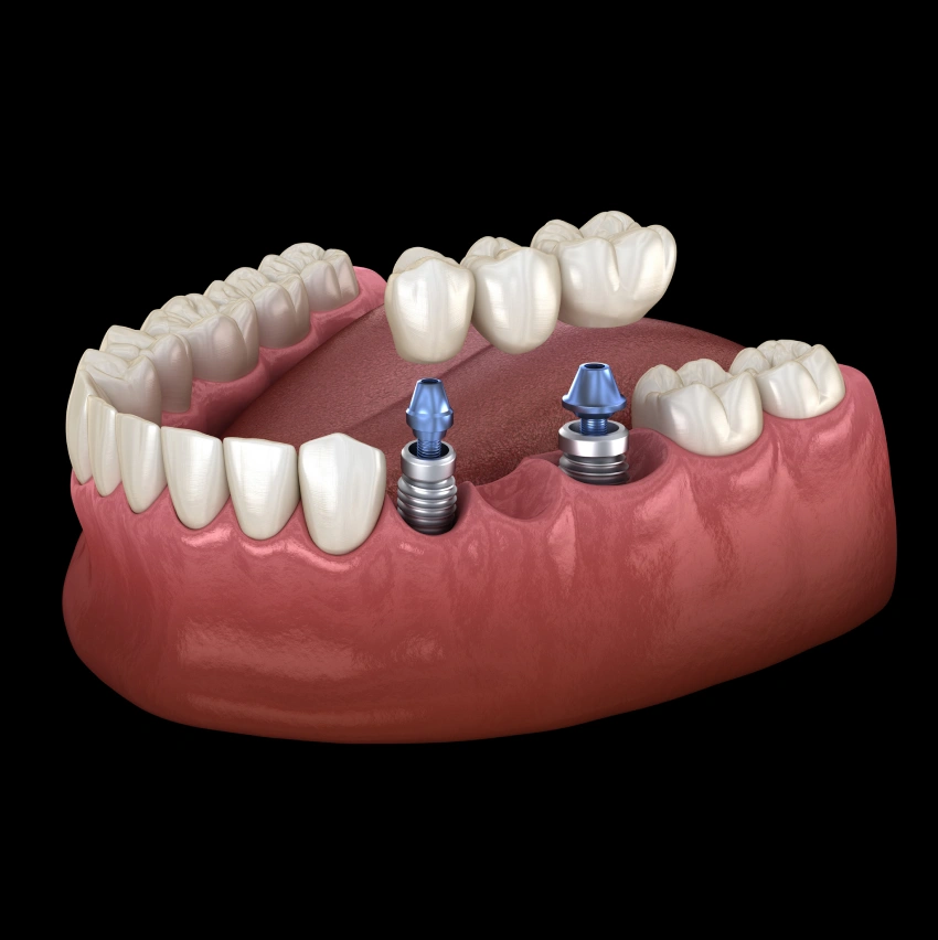 The Remarkable Advantages of Dental Implants