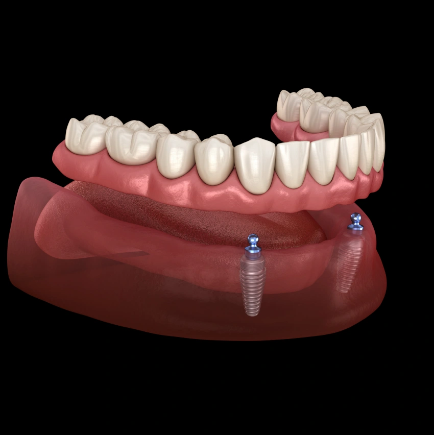 Discover the Ultimate Solution for Missing Teeth: Implant Dentures