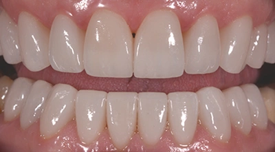 After mouth reconstruction restoring damaged teeth.